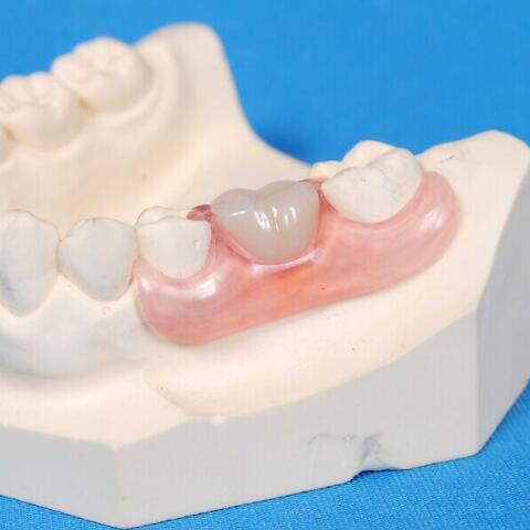 氮化硼补牙材料